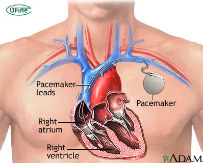 how does the battery affect pacemaker performance